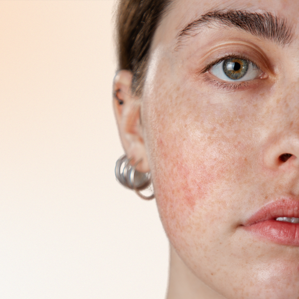 Rosacea/Sensitive