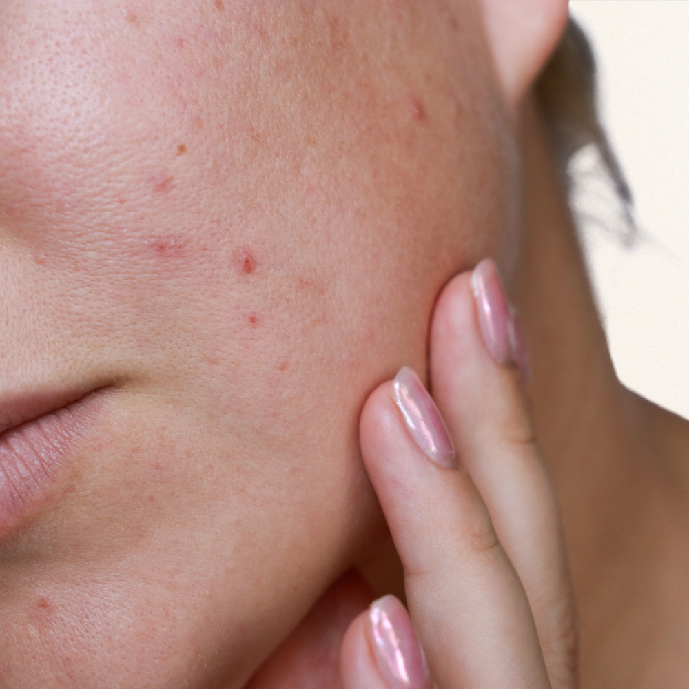 Acne & Congestion