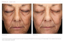 Before-and-After Visual Improvement after 20week of using Emepelle Night Cream and Serum