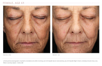 Before-and-After Visual Improvement after 20week of using Emepelle Night Cream and Serum