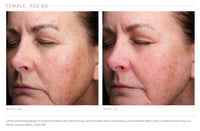 Before-and-After Visual Improvement after 20weeks of using Emepelle Serum and Night Cream glowing skin after using Emepelle skincare routine for hydration and firmnes